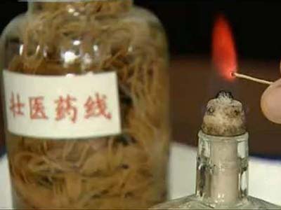 药线灸